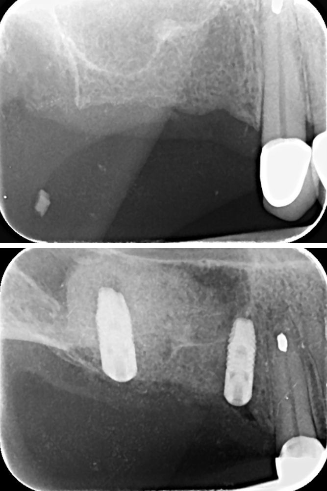 sinus lift herceg novi dr veselinović 2