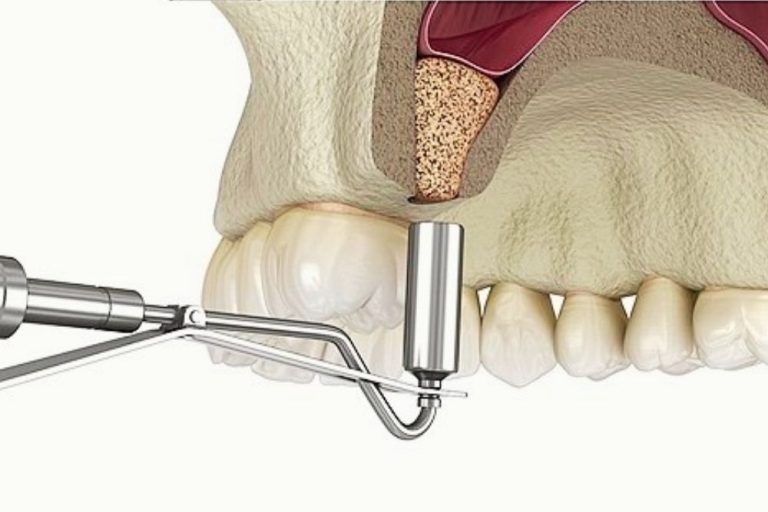 Implantat Sinuslift Chirurgie Periost Elevatoren Raspatorien