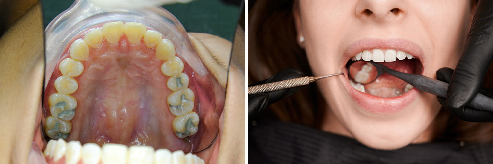 Aesthetic fillings Dental Fillings