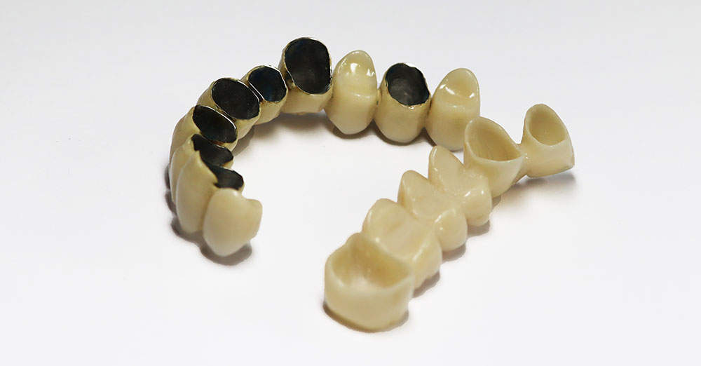 Crowns - Metal-ceramic and metal-free