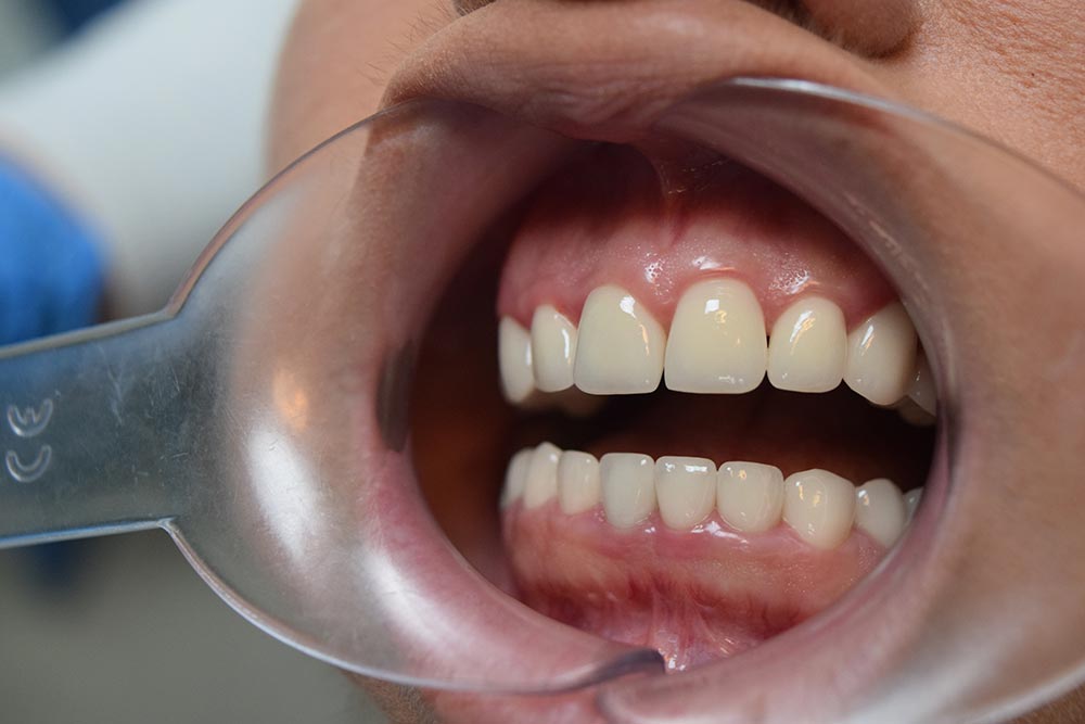 Dental prosthetics