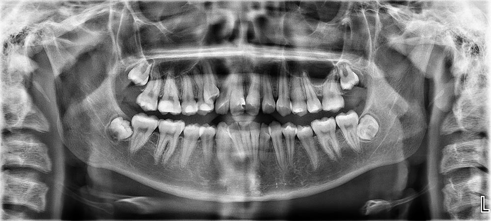 Impacted teeth