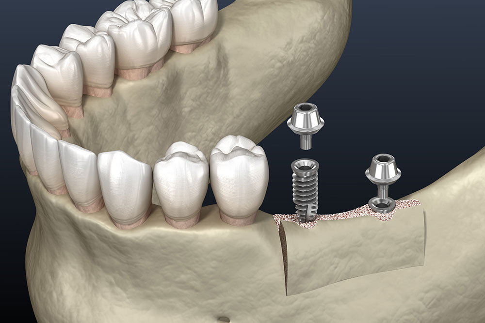 Operational flow – Jawbone augmentation 