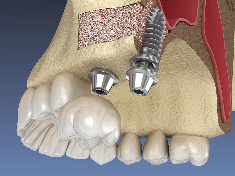 Sinus-lift