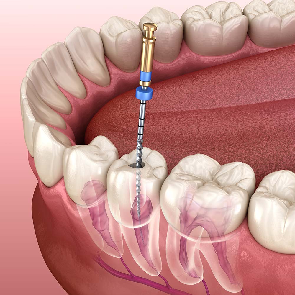 What does endodontic tooth treatment look like? 
