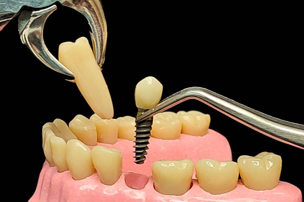 immediate implant placement dr veselinović 1