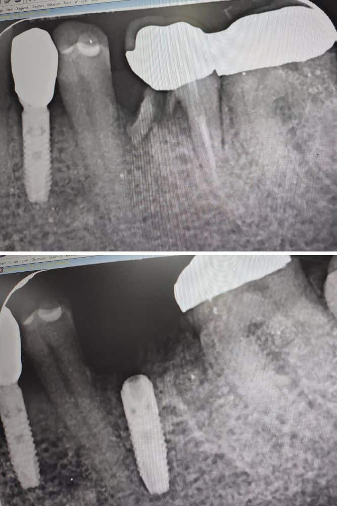 immediate implant placement dr veselinović 2