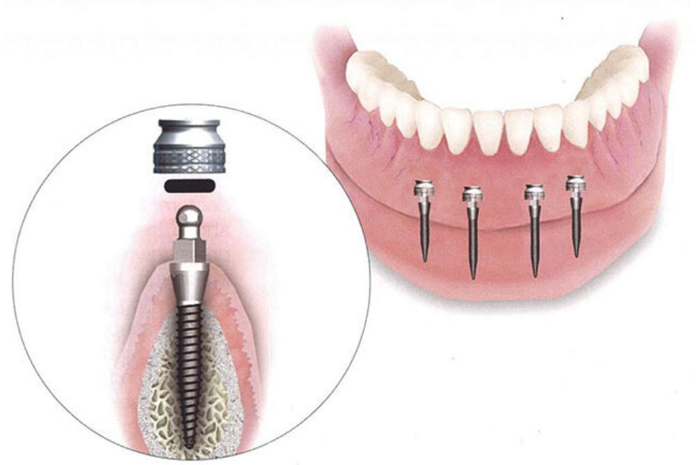 implant supported prosthesis dr veselinovic 1