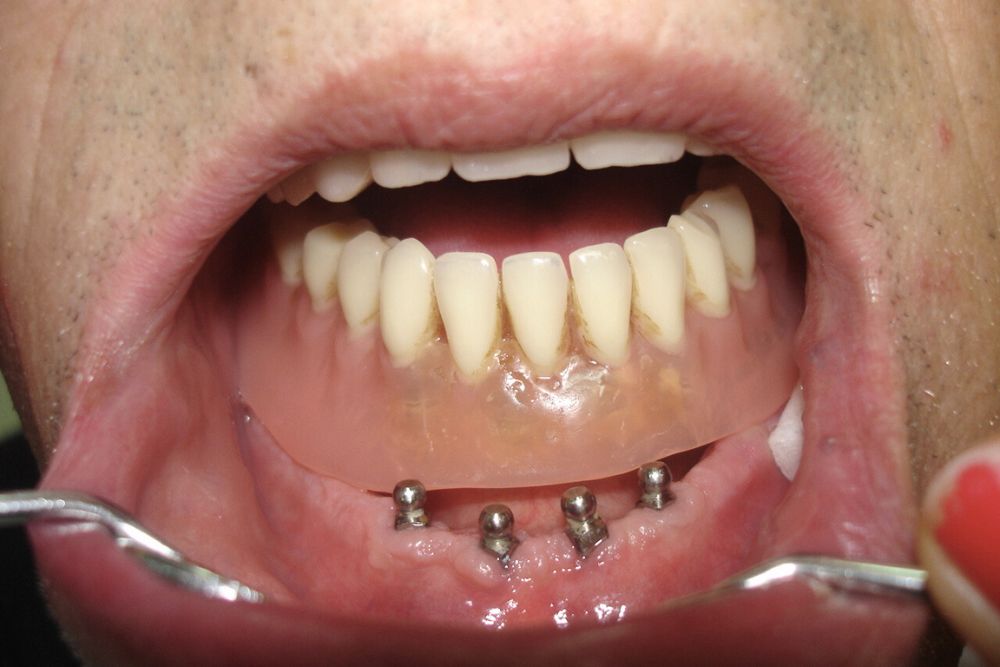 implant supported prosthesis dr veselinovic 2