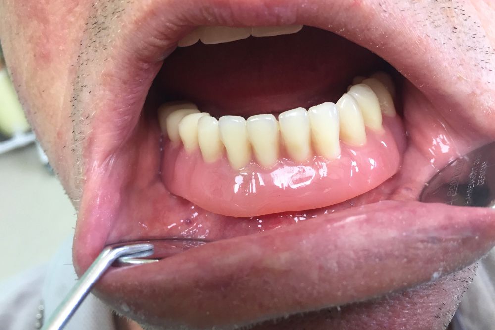 implant supported prosthesis dr veselinovic 3