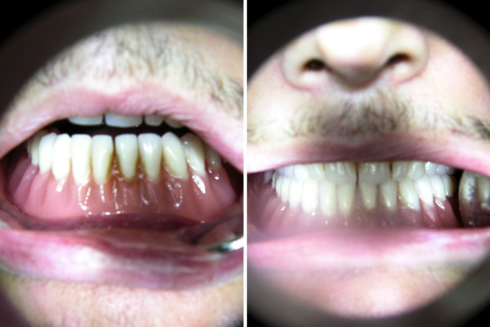 implant supported prosthesis dr veselinovic 4