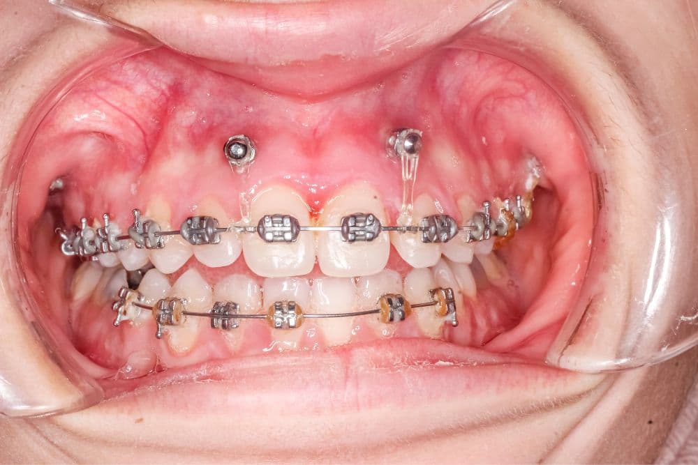 orthodontic mini implants dr veselinovic 1