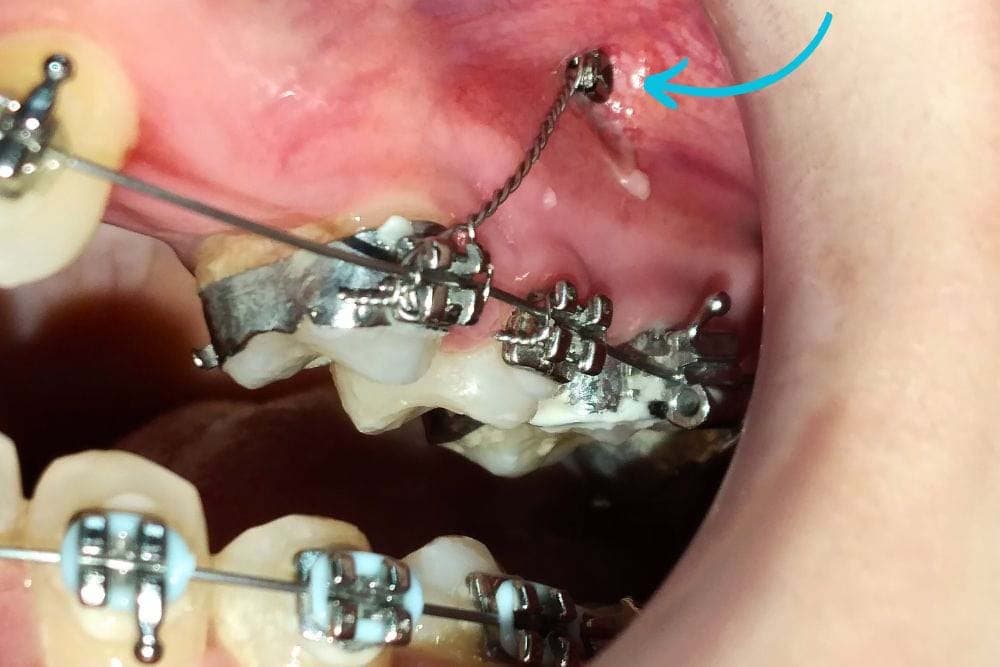 orthodontic mini implants dr veselinovic 2