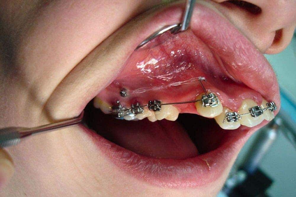 orthodontic mini implants dr veselinovic 3