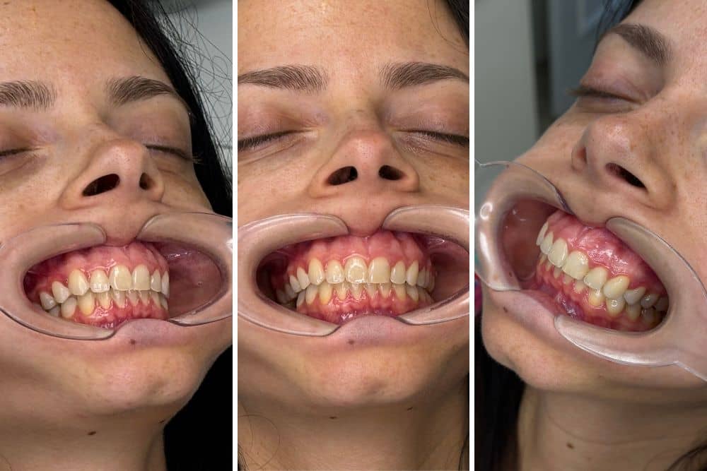 orthodontic mini implants dr veselinovic 4