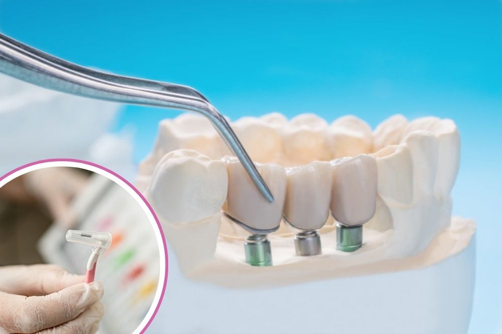 maintenance of dental implant hygiene dr veselinovic 1