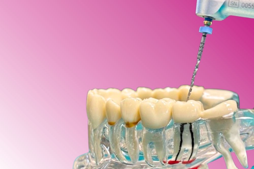 endodontic therapy dr veselinovic 1