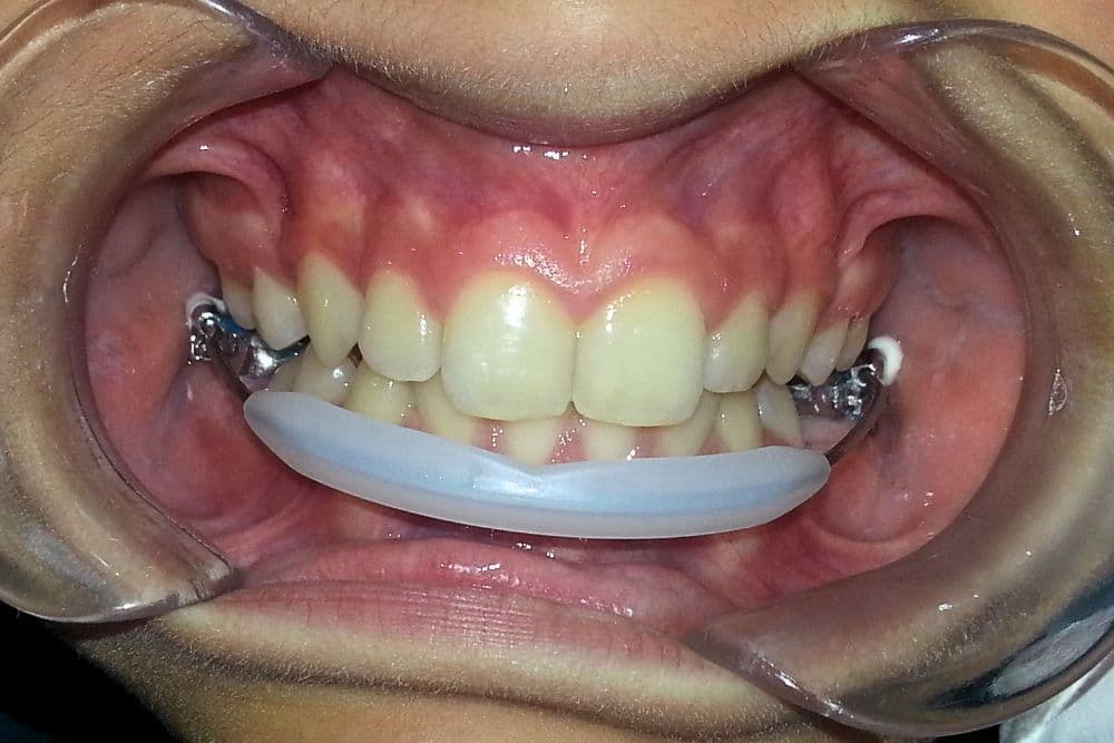 lip bumper dr veselinovic 1