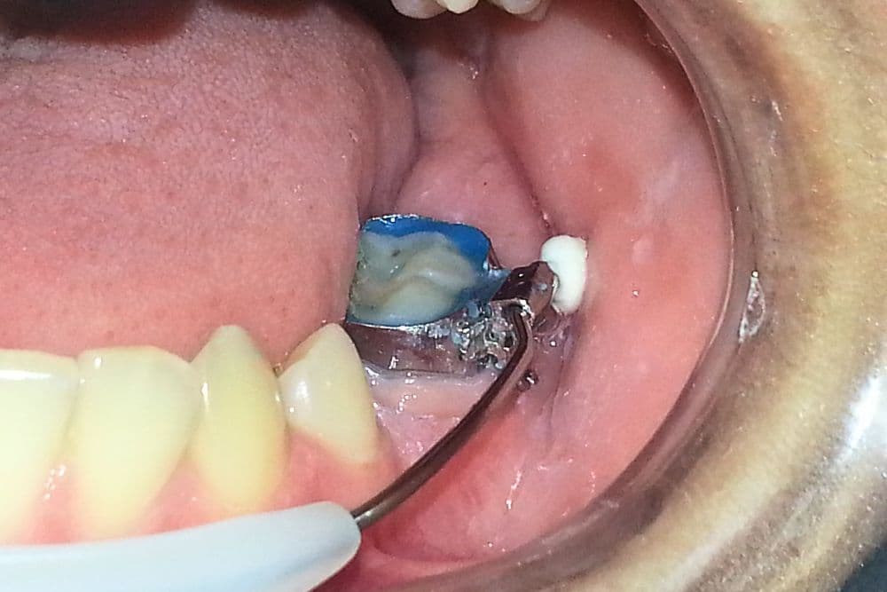 lip bumper dr veselinovic 2