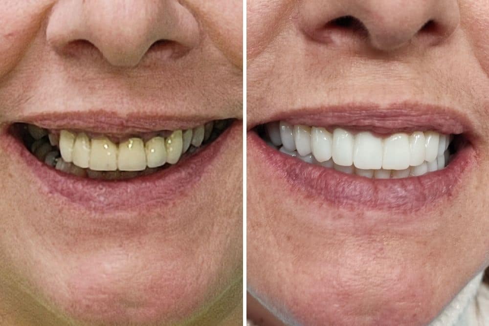 dental bridge dr veselinović 2