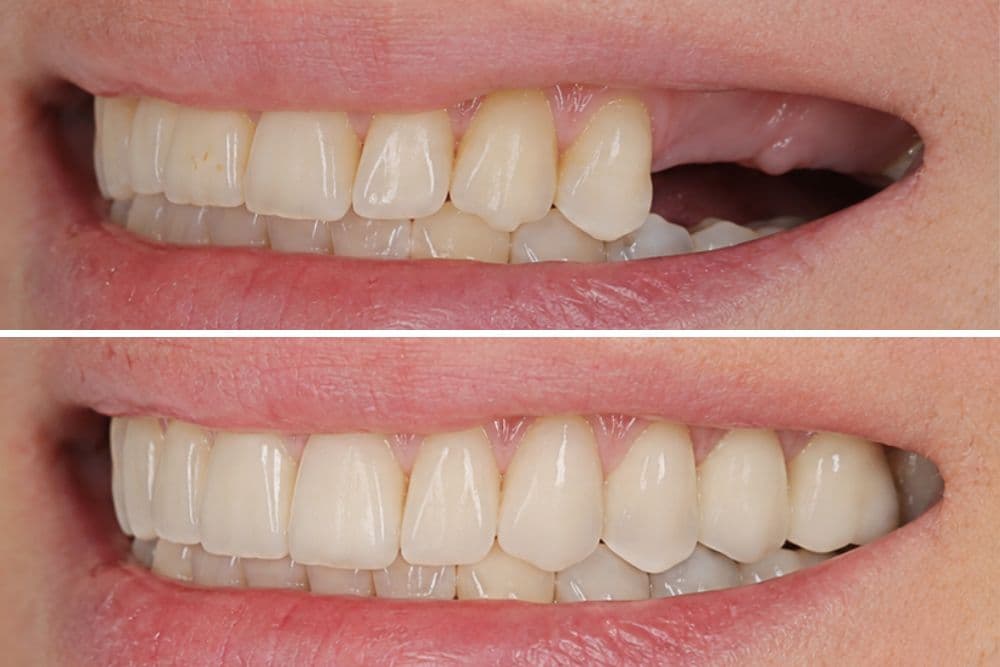 teeth bridges dr veselinović 5
