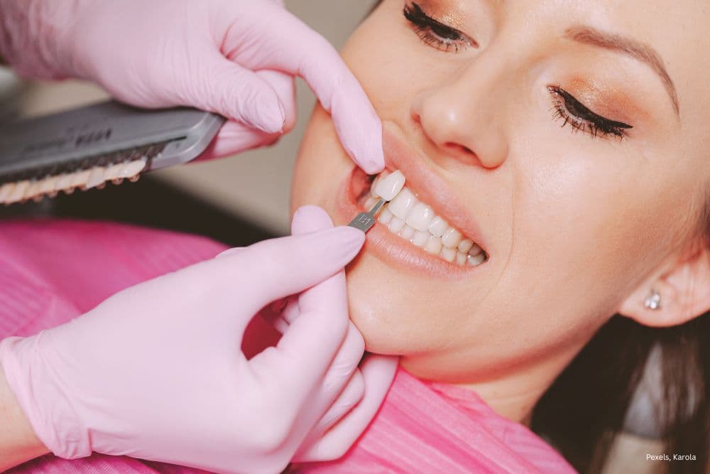 dental veneers dr veselinović 1