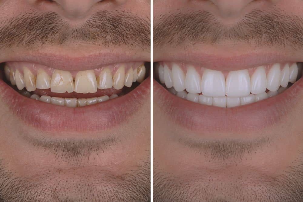dental veneers dr veselinović 3