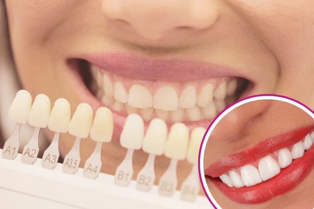 dental veneers dr veselinović 4