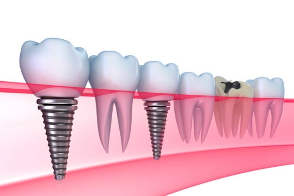 Gde u Beogradu možete pronaći zubne implante najvišeg kvaliteta?