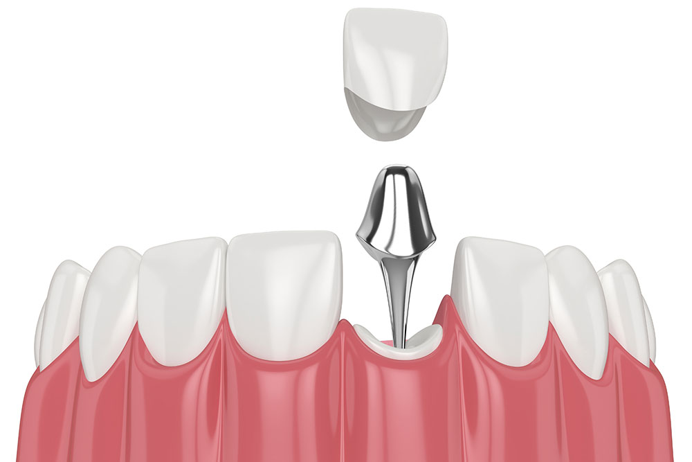 Konzervativna nadogradnja zuba