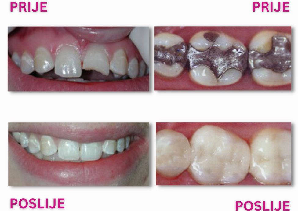 Konzervativna stomatologija - Plombiranje zuba