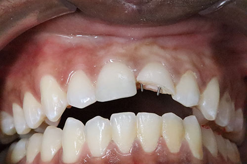 Parapulparni Kočići