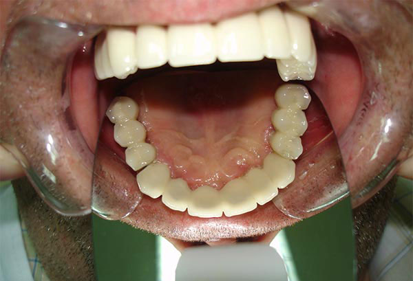 Stomatološka protetika i zubni implanti