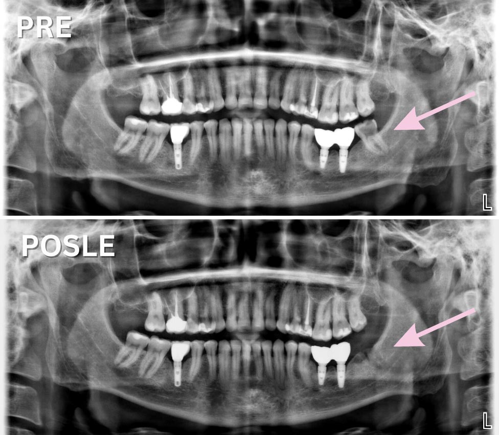 Vađenje zuba Dr Veselinović