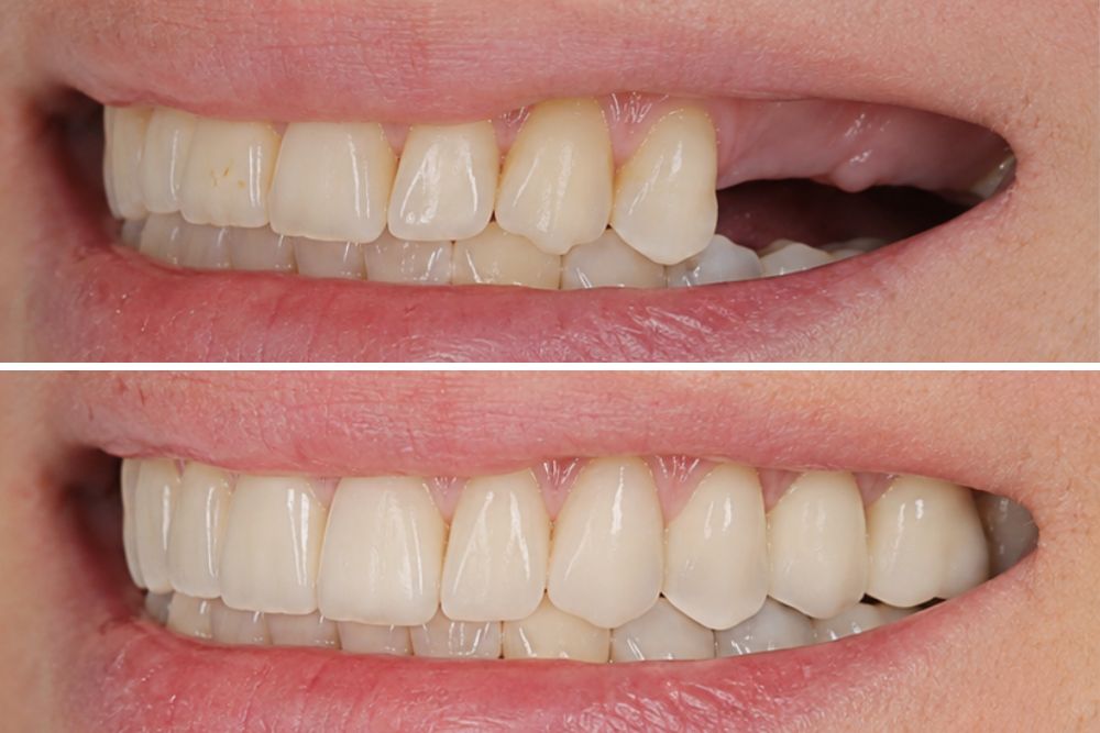 dentalni mostovi dr veselinović 1